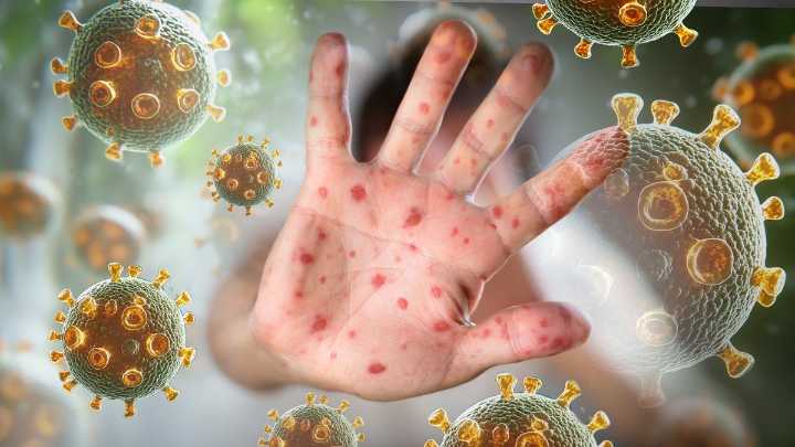 Measles: Several exposure sites in South West, Great Southern after two new cases confirmed