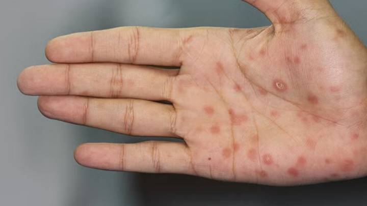 Sífilis se dispara en estos 7 estados; esto es todo lo que debes saber