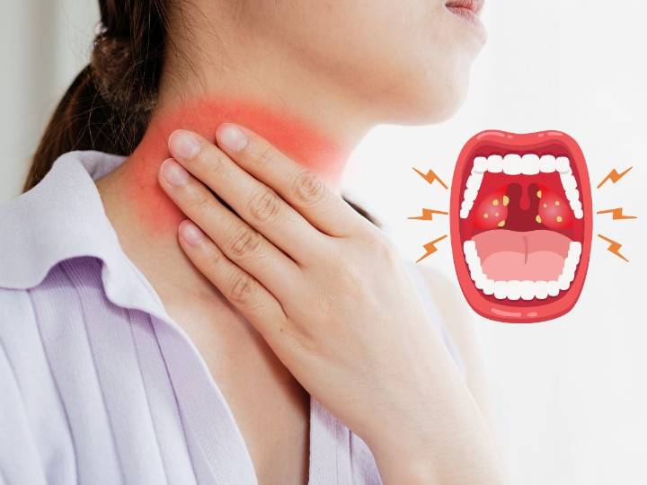 Amigdalitis en invierno: síntomas tempranos a detectar