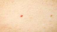 Qué son los lunares rojos que aparecen en el cuerpo y cuándo hay que preocuparse