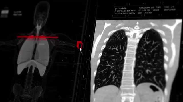 State of Lung Cancer 2025: Iowa lags behind in key factors