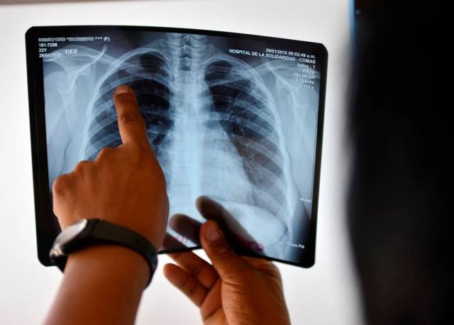 Pakistan among eight countries accounted for two-thirds of global TB cases