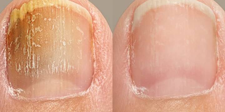 Cómo eliminar hongos en las uñas de los pies o de las manos de forma casera y sin correr riesgo de reinfección