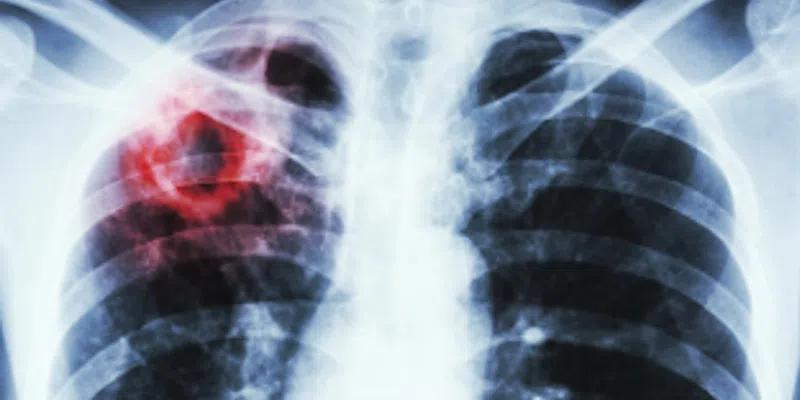 TB Outbreak Reported on North Coast of Labrador