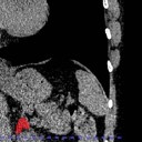 AI detects first physical signs of chronic stress
