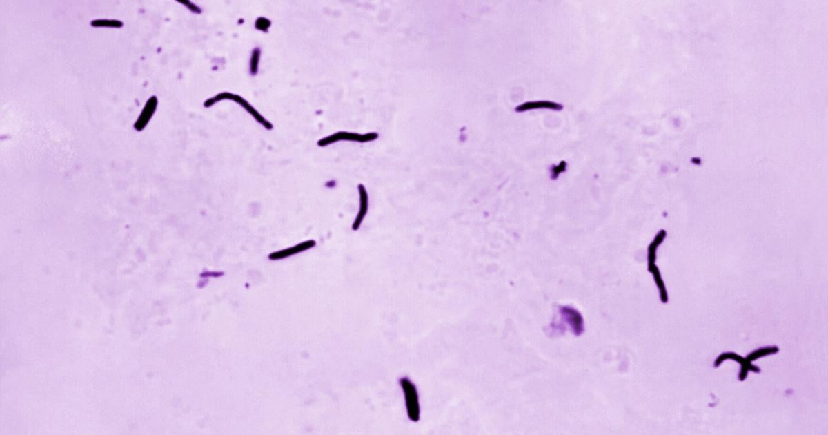 Global tuberculosis diagnoses rise to a record, but deaths fall, WHO reports