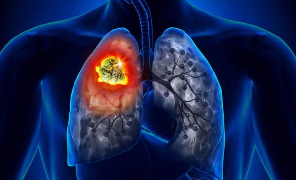 Cáncer de pulmón: alertan por el aumento de casos y el estudio clave que puede prevenir