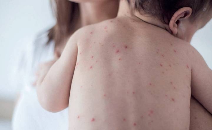 El ministerio de Salud emitió un alerta epidemiológica por nuevos casos de sarampión