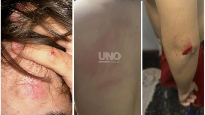 Brutal agresión en Santo Tomé: un hombre de 52 años golpeó con un palo a un adolescente tras una pelea entre perros