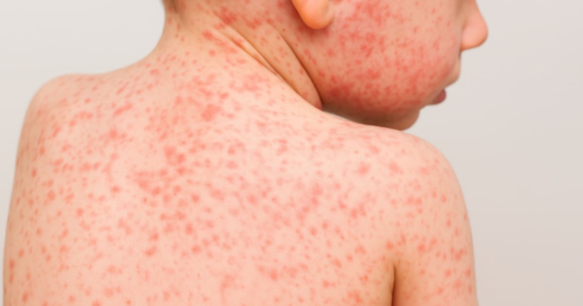 Aumentan los casos de sarampión en el mundo: OMS alerta riesgo de nuevos brotes por baja vacunación