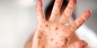 S.C. measles outbreak reaches 62 as holiday travel continues