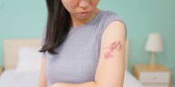 ¿Qué es el herpes zóster? Esto es lo básico que debes saber sobre la enfermedad