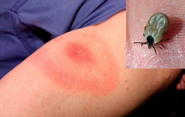 Supera este año Rickettsiosis casos y muertes un 15.9% al 2024