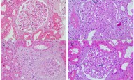 Rare Dual Diagnosis: Alport Syndrome and Immune Complex-Mediated MPGN Coexist in the Same Patient