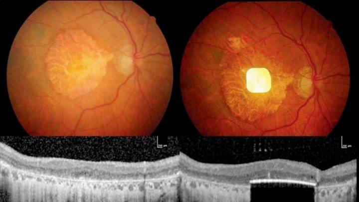 New eye implant helps blind patients read letters, numbers and words