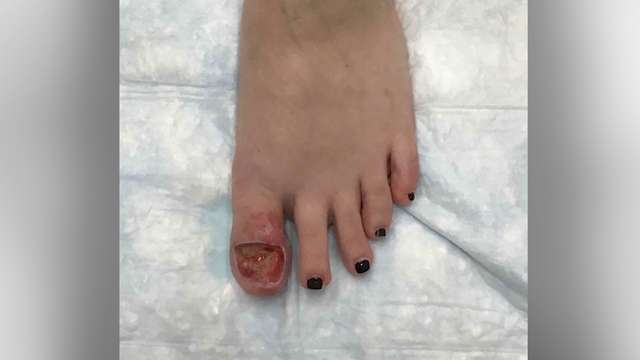 Woman's lifelong birthmark becomes deadly cancer, doctor explains how