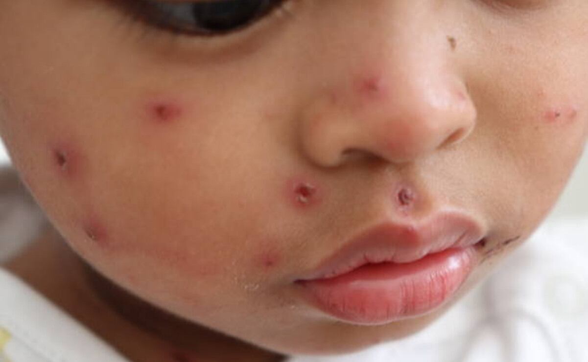 Canadá pierde estatus de país libre de sarampión; reportan baja tasa de vacunación en comunidades cristianas menonitas