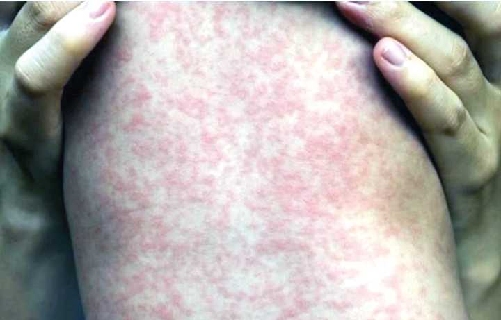 Advierte OPS por brote de sarampión en México