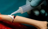 Crean un pegamento para huesos que promete reparar fracturas en tiempo récord