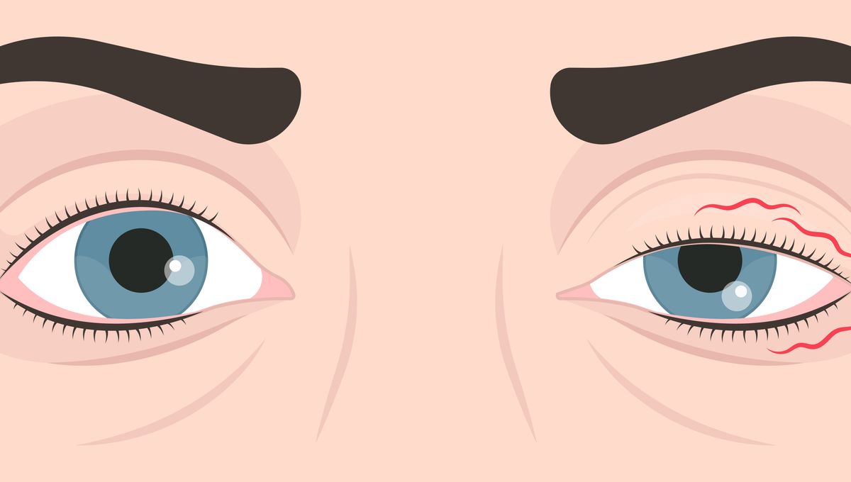 Ocular Myokymia; Or, Why Is My Eye Twitching Like That?