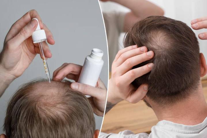 Experimental serum could reverse baldness within 20 days