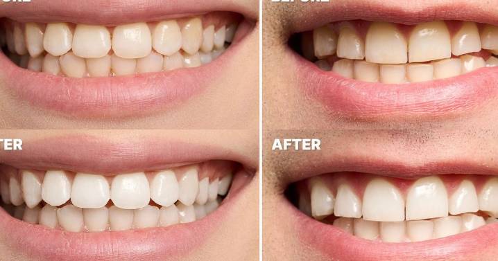 Tea and coffee drinkers turn to 55p teeth whitening strips that 'show results fast'