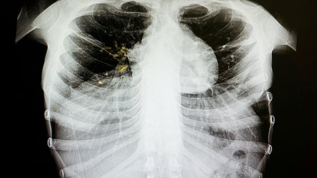 Tuberculosis outbreak declared in inner-city Edmonton: Primary Care Alberta