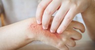 New eczema treatment approved for NHS use 'will help 62,000'