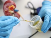 Cambios en la orina que alertan enfermedad renal crónica