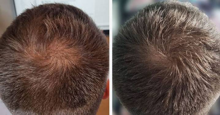 Hair loss sufferer gets 'thicker' locks after 65p-a-day tablet worked in '3 weeks'
