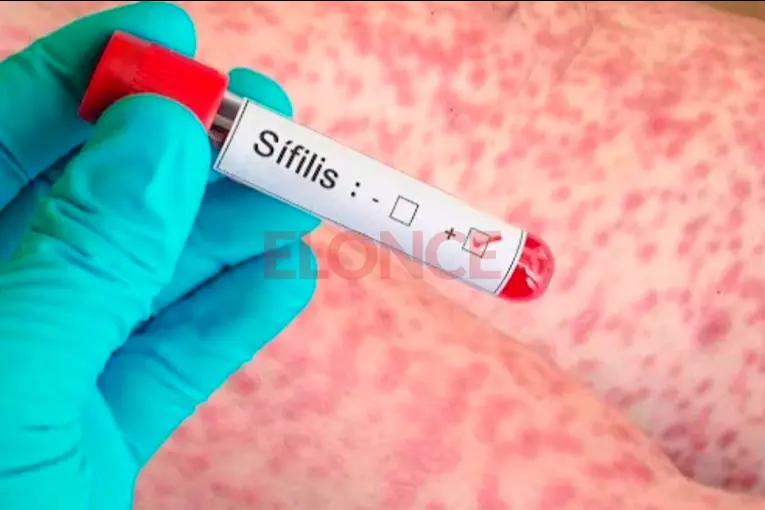 Aumentaron los casos de sífilis en Entre Ríos: "El 98% de las infecciones se dan por relaciones sin protección"