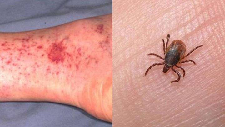 Deja Rickettsia 45 muertes y 95 casos confirmados en Chohuahua