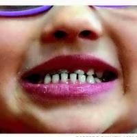 FDA restricts kids' fluoride supplements