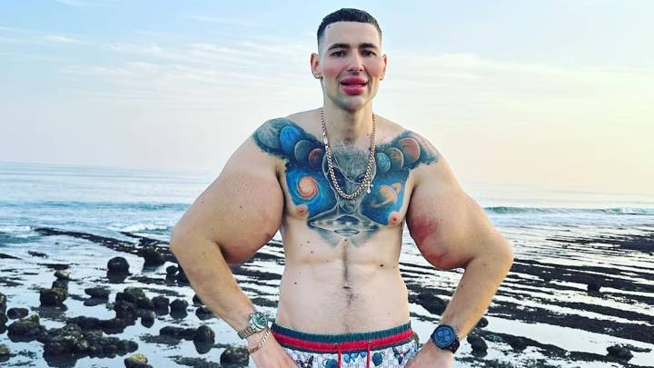 El «Popeye ruso» enfrenta la amputación doble de brazos tras inyectarse vaselina y Synthol