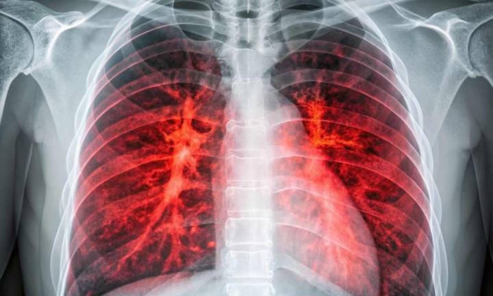 Inflammation may be responsible for driving earliest stages of lung cancer, suggests research