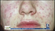 Measles cases reach 182 in Arizona-Utah region east of Las Vegas; U.S. 'elimination' status at stake