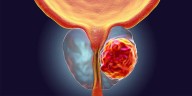 Las pesquisas son importantes para prevenir el cáncer de próstata
