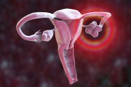 Four Subtypes of Polycystic Ovary Syndrome Identified