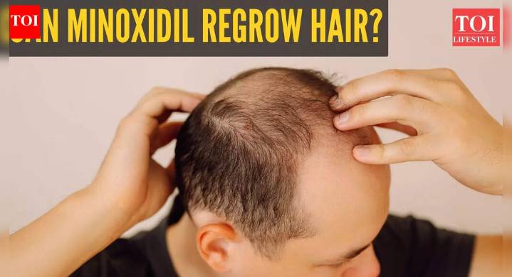 Hair Growth: Can minoxidil help with hair growth? Online claims send the treatment trending