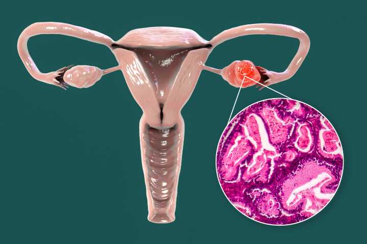 Blood Test Helps Identify Ovarian Cancer Patients for PARP Therapy