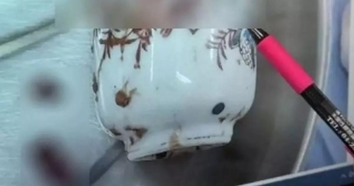Man has surgery after getting ceramic mug stuck up his bum
