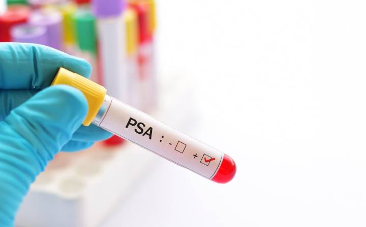 Cáncer de próstata: latente amenaza para los hombres