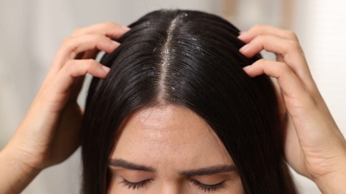 Flaky Scalp and Dandruff Season: A Dermatologist’s Guide to a Healthy Winter Scalp