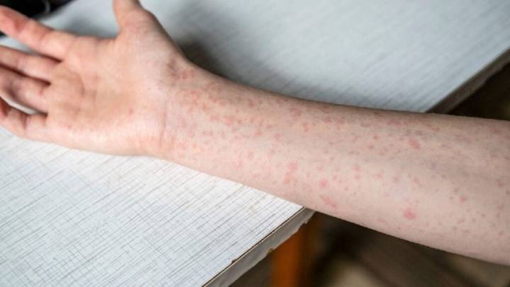 Las muertes por sarampión caen un 88% desde 2000, pero los casos aumentan, alerta OMS