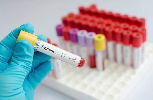 Los casos de sífilis subieron 45% en un año en Tucumán