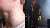 Queensland Health warns of possible measles outbreak after infectious fans attend Jelly Roll concert in Brisbane