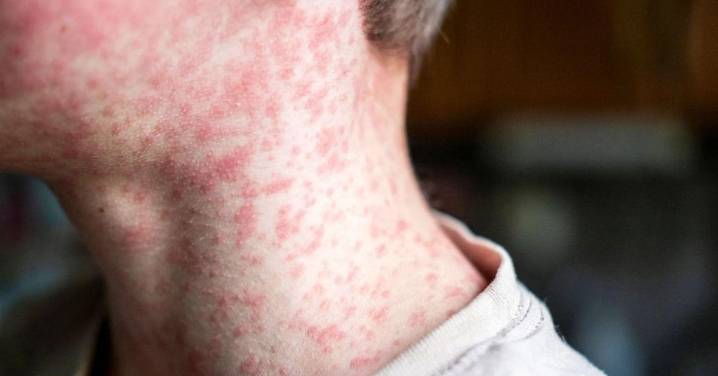 Los casos de sarampión crecen pese a la reducción de muertes