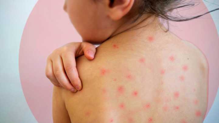 Incrementa a 102 los casos probables de sarampión en Hidalgo