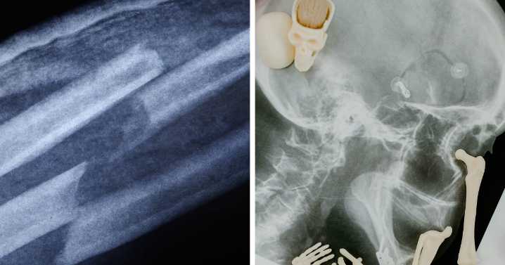 Broken Bone Theory: The TikTok Trend Making Superstition Weirdly Hilarious
