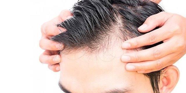 4 razones para realizar un injerto capilar en Madrid